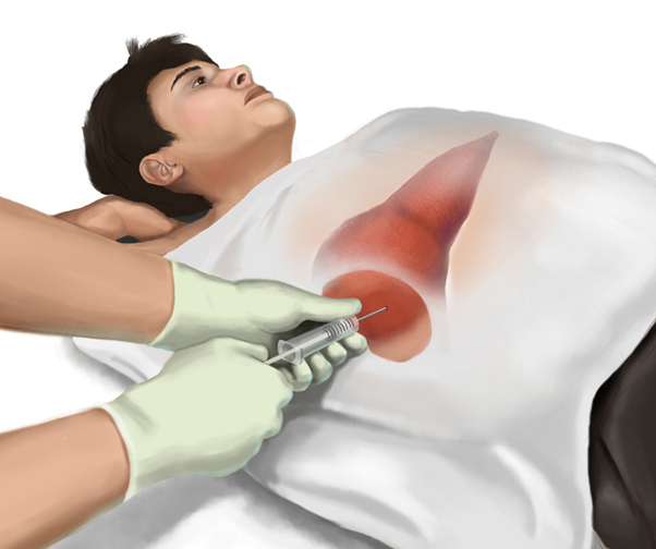 Liver Biopsy